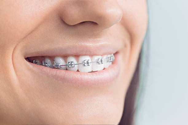 Best Veneers and Lumineers  in Western Lake, TX